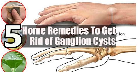 How Do You Get Ganglion Cyst On Your Foot - Margaret Greene Kapsels