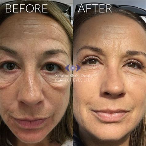 Natural Looking Eye Bag Surgery | By Leading Cosmetic Eye Surgeon