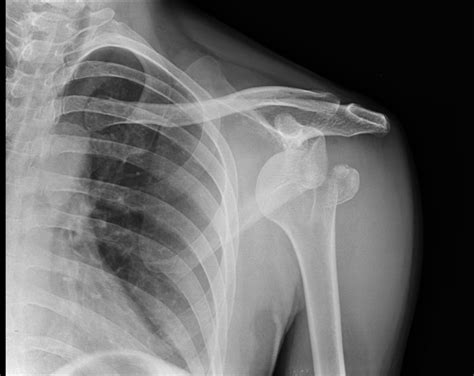 ANTERIOR SHOULDER DISLOCATION WITH FRACTURE | Buyxraysonline