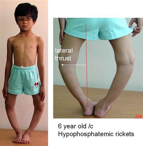 Hypophosphatemic rickets causes, symptoms, diagnosis, treatment & prognosis