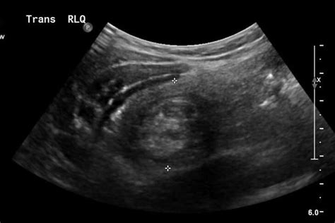 Intussusception | UAMS Department of Radiology