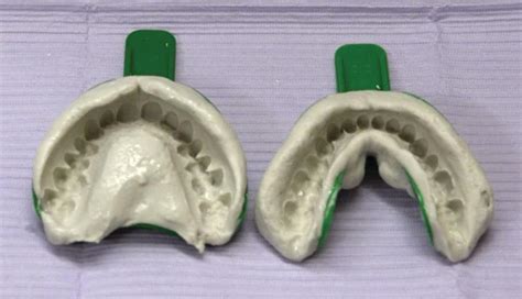 3: Alginate Impressions | Pocket Dentistry