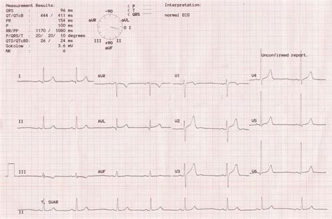 Electrical Axis – All About Cardiovascular System and Disorders