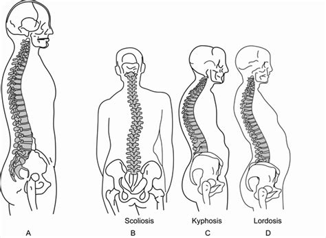 Abnormal Spine Curvatures - Chiropractic Healing Center