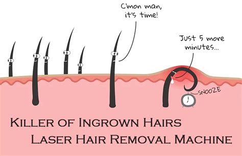 Killer of Ingrown Hairs – Laser Hair Removal Machine - Stelle Laser