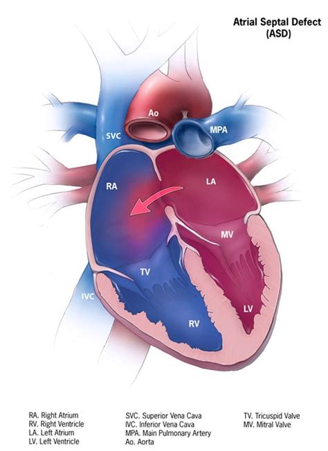 Ventricular Septal Defect Types