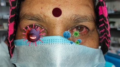 Pink eye or Madras Eye or Eye infection and it's prevention - YouTube