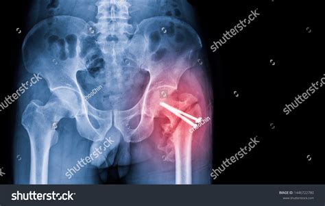 Hip Fracture Xray Photo Image Xray Stock Photo 1446722780 | Shutterstock