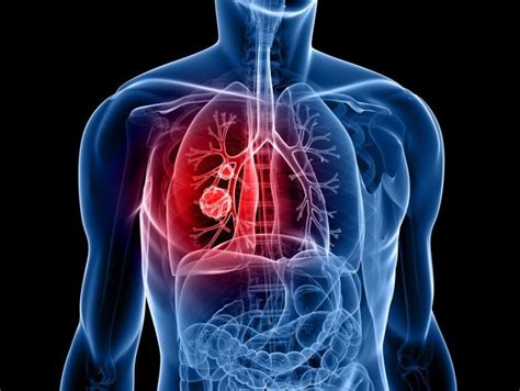 Common Causes of Lung Cancer - Detailed Review!