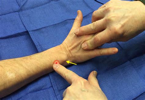 Extensor Carpi Ulnaris (ECU) Tenderness | Hand Surgery Resource