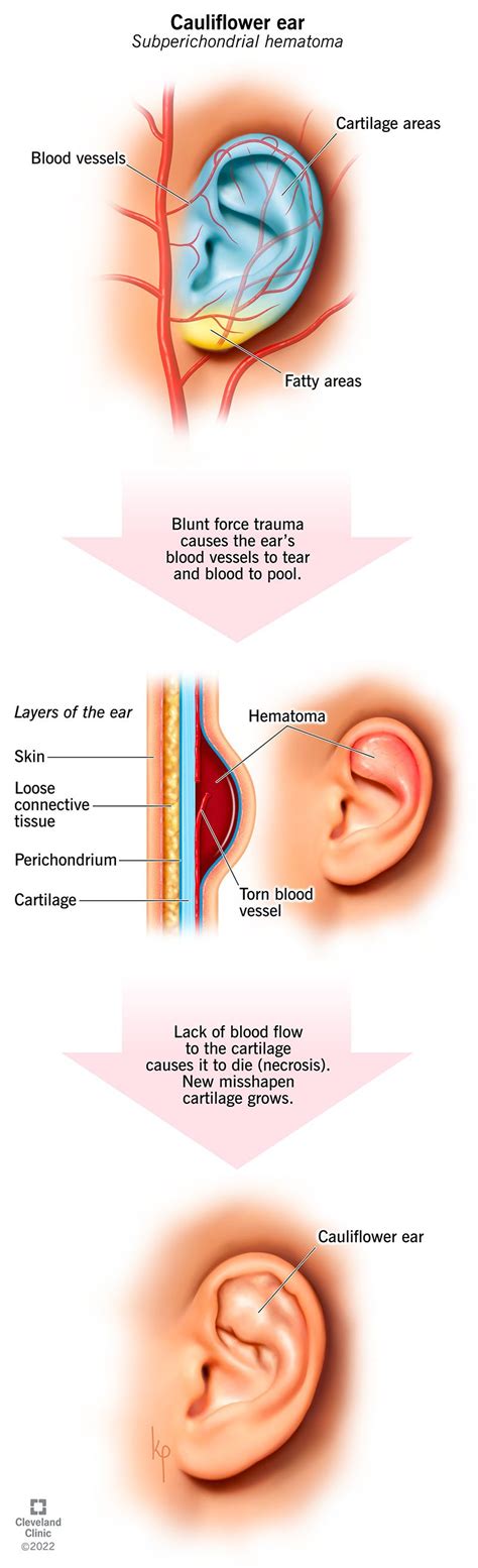 Cauliflower Ear: What It Is, Causes & Treatment