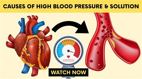 Top Causes of High Blood Pressure & How to Prevent It Without ...