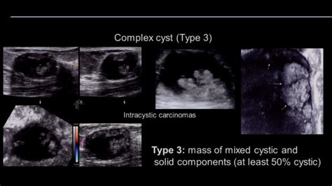 Breast Cyst Ultrasound