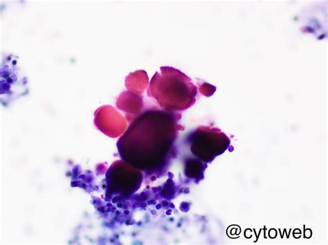 May 2021: Strange finding in a bronchoalveolar lavage fluid | Cytoweb – Practical Cytopathology