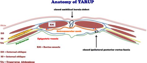 Anatomical drawing of the technique of minimal invasive transabdominal... | Download Scientific ...