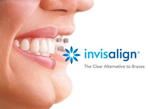 Invisalign Pros and Cons of Invisible Braces - Thomas L. Anderson DDS