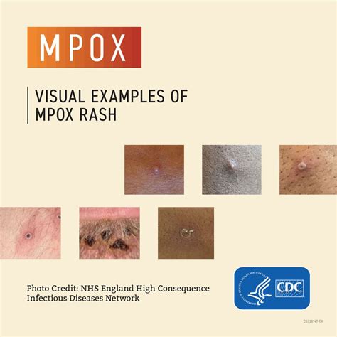 Mpox | Shelby County Health Dept., TN