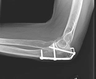 Fractures of the Olecranon and Proximal Ulna - Cancer Therapy Advisor