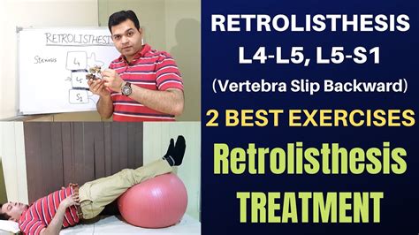 Retrolisthesis- 2 Exercises For Retrolisthesis L4-L5, L5-S1 Treatment ...