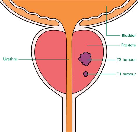 Prostate Cancer Staging And Grading