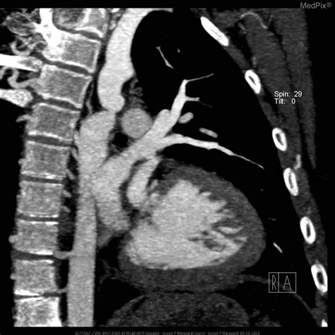 Turner syndrome CT - wikidoc