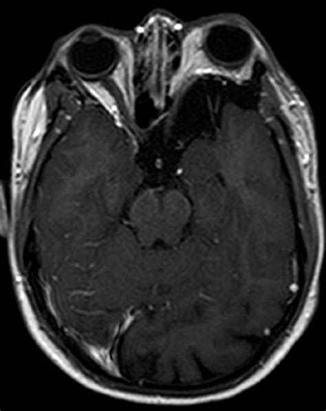 Sphenoid Wing Dysplasia - Neuro MR Case Studies - CTisus CT Scanning