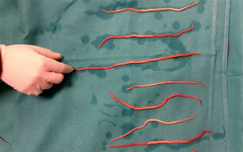 Doctors Pulled 14 Squirming Roundworms from a Woman's Bile Ducts | Live Science