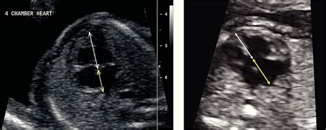 Atrioventricular Septal Defect Ultrasound