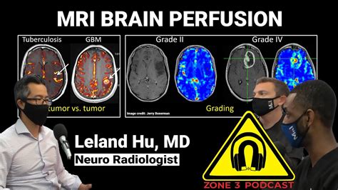 The Value of MRI Brain Perfusion when evaluating Brain Tumors Like ...