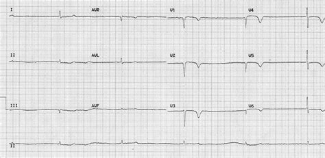 Hypothyroidism ECG changes • LITFL • ECG Library