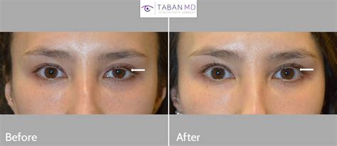 Eyelid Ptosis Before and After Gallery | Taban MD