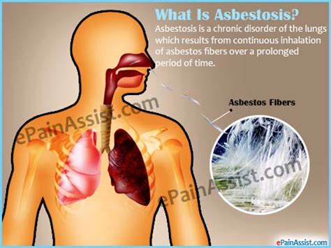 Asbestosis Prognosis in Lung? + Life Expectancy & Survival Rate | Mesothelioma Treatment Centers.org