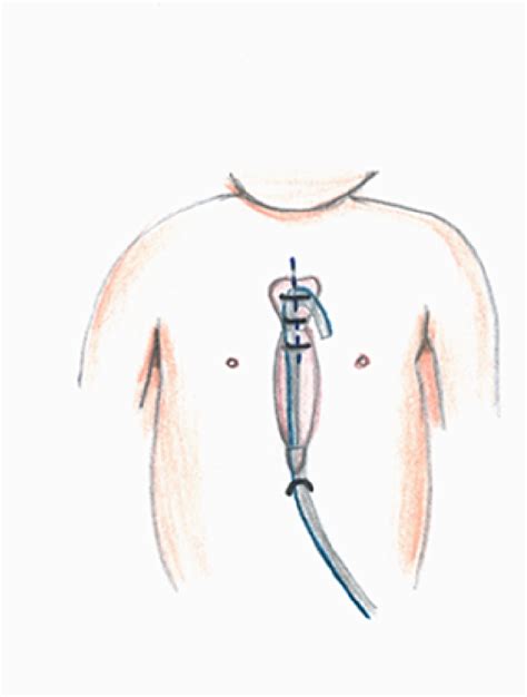 Figure 7 from Partial upper median sternotomy for anterior aortopexy for innominate artery ...