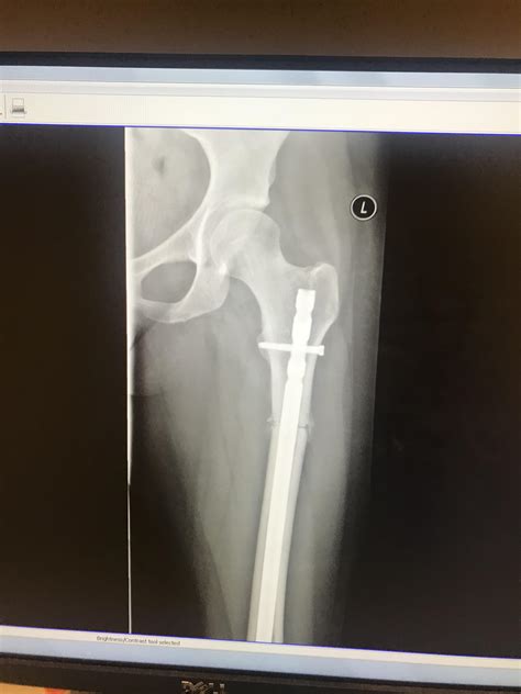 Post-op X-ray from my derotational femoral osteotomy. Surgery performed to correct femoral ...