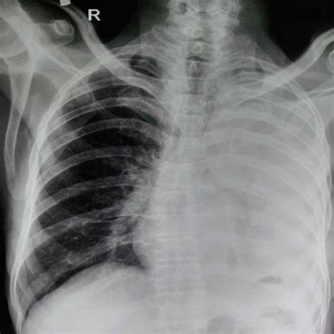 A Chest X Ray Showing Right Sided Pneumothorax Collap - vrogue.co