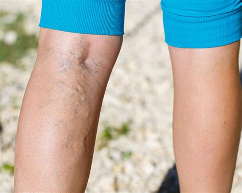 3 Different Types of Varicose Veins | Vein Center in Walnut Creek, Brentwood, and Oakland