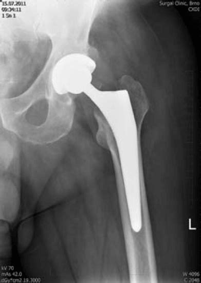 Hip Replacement Surgery Abroad | Endoprosthesis Surgery in Prague