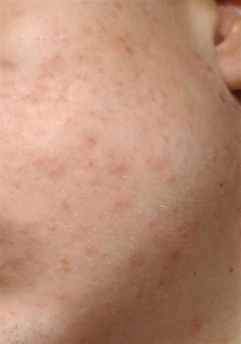 [Acne] Red dots on face that's not pimples? : r/SkincareAddiction