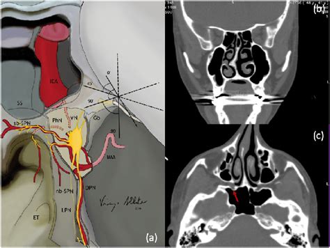 a) Anatomical illustration of the SPG. VN Vidian Nerve; PhN... | Download Scientific Diagram