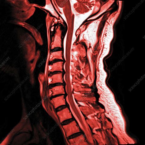 Degenerative cervical spine, MRI sequence - Stock Video Clip - K004/6590 - Science Photo Library