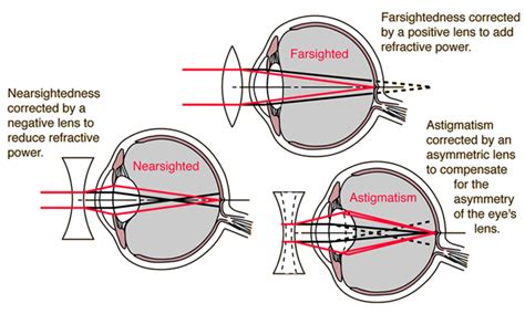 Common Eye Defects