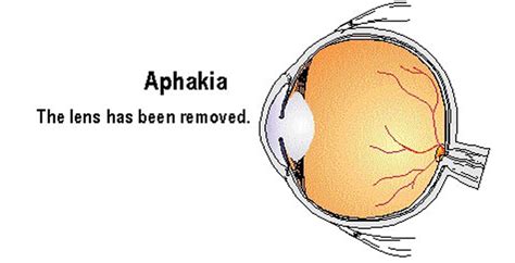 Aphakia Symptoms | Treatment for Aphakia - SIMS Hospital Chennai