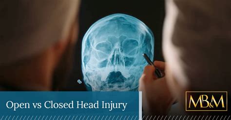 How Do Open and Closed Head Injuries Differ? | Providence, RI