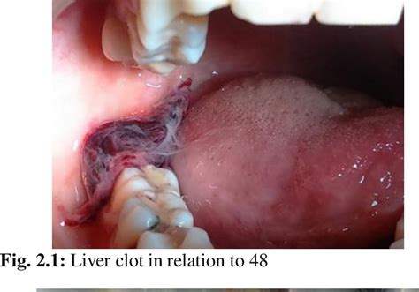 Figure 1.1 from Liver clot- A rare post-operative complication following tooth extraction ...