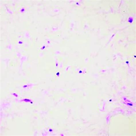 Photomicrograph shows randomly arranged stellate cells in a loose ...