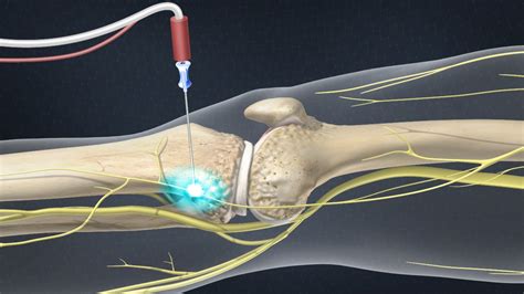 Genicular Nerve Ablation - Coastal Spine and Pain