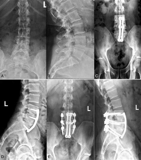 L5 s1 fusion surgery