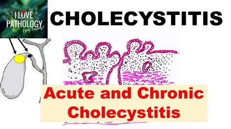 Cholecystitis Histology