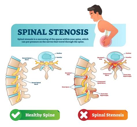 Spinal Stenosis Types Causes Symptoms Diagnosis Treatment Risks | My XXX Hot Girl