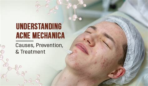 Understanding Acne Mechanica: Causes and Treatment | Acne Wiki